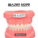 [셉템버교정치과] &#39;덧니가 심해요&#39; 발치교정 케이스 이야기