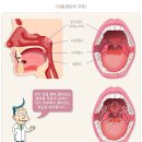 편도염 수술비보장 특별약관(보험금의 지급사유) 이미지
