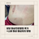 대인병원 | [육아일기] 분당 화상전문병원 대인외과oo 후기 #소아 화상 응급처치, #흉터 관리