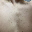 진차이 | 신사역편평사마귀 피부과에서 시술후 좋아진 피부 차이 후기