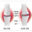 무릎관절 - 퇴행성으로 오는 무릎관절염 증상 치료 이미지