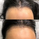 대건빌딩 | 넓은이마 무통 헤어라인 반영구 시술후기! 강남 반영구 아카데미 투엠메이크업