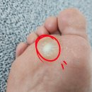 임마누엘피부과의원 | 발바닥 사마귀 치료 후기(사진 혐 주의, 광고 X)