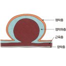 위장관 기질적 종양(Stomach GIST) 이미지