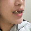 백석미소담은치과의원 | 주걱턱 시술로 턱 얼마나 들어가요? 실제 전후 사례 비교 분석