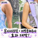 바이차이주 | 신논현피부과 팔뚝 온다리프팅 10만줄 + 지방분해주사 효과 가격 후기
