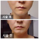 자연스럽게 또렷해진 얼굴, 압구정피부과 실리프팅 솔직 후기