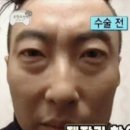 고랑들 | [눈밑지#준비1] : 눈물 고랑 꺼짐+병원 상담 후기