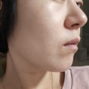 청담동피부과 오푸스 레이저 후기 - 피부고민 해결