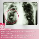 질병 &#34;폐결핵 Pulmonary tuberculosis&#34; 이미지