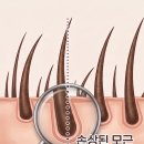 보이지 | 서면이마축소 후기에서 보이지 않는 흉터 정말일까요?<임온원장>