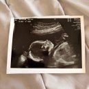 미소퀸의원 | 25년 12월-26년 1월_임신 21주-25주_임신 중기/임신 중기 증상/임신 중기 검사/대학병원 전원/cpc...