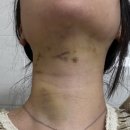 순리대로내몸건강 | [이중턱 지방흡입-1] 발품부터 3일차 까지 리얼 모든걸 까버리는 후기 (사설 매우 많음)