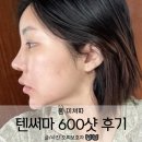 강남구청역피부과 써마지통증 보다 덜 한 텐써마600샷 후기 + RF4#(알에프포샵)스킨부스터