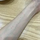 성경제피부과의원 | 만성 특발성 두드러기/대학병원 진료/졸레어 주사 1차 접종 후기 (~ing)