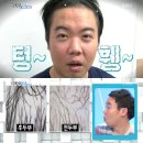 탈모왕