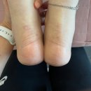 척추측만증 환자 분당 판교 자세 체형교정 후기 및 가격 / 연예인도 받는 체형 관리 프로그램