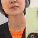 시  목 | 목주름레이저 스킨부스터 가로 목주름관리 후기 및 가격