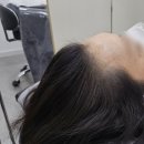 촘촘 스칼프 | 안양탈모관리 M자탈모관리 디랩스칼프 2차 후기