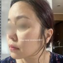 구월동 피부과 티타늄 리프팅 슈링크 유니버스 통증 붓기 후기