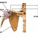 견갑골 견봉 골절의 정의, 증상, 원인 및 치료 이미지