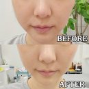 초이스뷰티 | 김포 구래동피부관리 맛집 초이스뷰티 물방울리프팅 후기