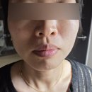 시지피부관리 리주비 스킨앤왁싱 멜라소닉토닝+듀얼리프팅 솔직후기