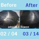 두피 탈모 아미치 0.3 수원점 이미지