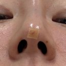 비너스짐 | 비너스코 6줄 한달 후기 (2번째 시술, 유지기간 늘리는 전략)