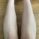 진주 종아리 보톡스 후기! : 강남JC성형외과의원