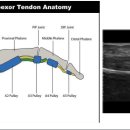 근골격계 Finger sono자료 (방아쇠수지증후군) 이미지