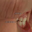 민치과 앞 | 5세 어린이 프랑켈 교정 병원 후기 3탄 (압구정민치과)