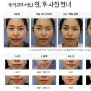 브이라인