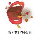 고혈당 증상 당뇨병성 케톤산증 &amp; 쿠스마울 호흡 이미지