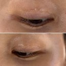 킴스꼬마김밥 | <아토피 탈스 기록 13탄> 흉터제거 ㅣ 레이저치료 아토피 흉터 ㅣ 알고보니 먹빵로그 ㅣ 만겹 크루아상🥐