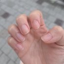 하나이비인후과 | 하나이비인후과 편도절제술 후기(1일차, 2일차) (입원, 4인실 준비물, 통증, 식사)