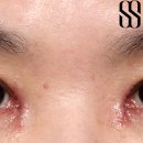 시선성형외과의원 네이버블로그