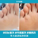 체계적인 발 관리 강동구발관리 풋스올에서 시원하게 티눈 제거 한 후기