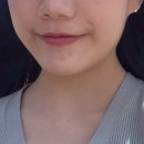 홀드의원 | [피부과추천] 강남 홀드의원 티타늄리프팅 솔직 후기💓 | 피부관리 | 피부과추천 | 강남피부과