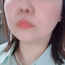 (주)메타뷰 | 볼살 리프팅 하고 싶어서 받은 내돈내산 온다리프팅 효과, 통증 후기