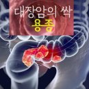 대장암의 씨앗 &#39;대장용종&#39; 자꾸 생기는 이유 이미지