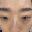 (주)제노메디칼 | 대구에스테틱 홍화뷰티 피코토닝 피코프락셀로 기미관리 후기