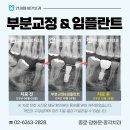 30대 부분교정 후기, 쓰러진 치아 치료 전후 광화문치과