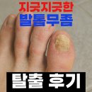 온약국 | 발톱무좀 없애는 방법, &#39;이 성분&#39; 없으면 효과 없어요! (ft. 메디셀온, 약국, 솔직 후기)