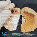 이솜치과의원 | 어금니 임플란트 방법 두가지 비교(gif움짤)