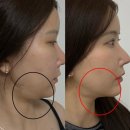 라임디자인 - 하남시 검단산로146번길 79-8 | 강남역 성형외과 울쎄라피프라임 400샷 찐 후기