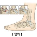 발목부상시 필요한 하체운동 [영상포함] 이미지