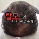 아산두피문신 가격,부작용,통증까지 총정리! 이미지