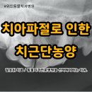 위드(with)치과기공소 | 치아 파절로 인한 &#34;치근단농양&#34;