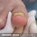 강남병원 | 강남 발톱무좀 치료 병원 대신 케어 후기